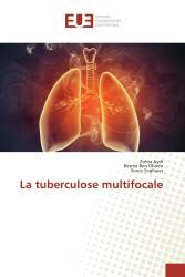 La tuberculose multifocale