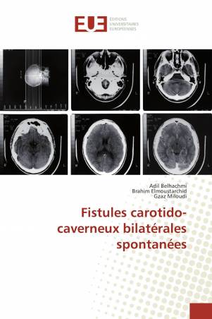 Fistules carotido-caverneux bilatérales spontanées