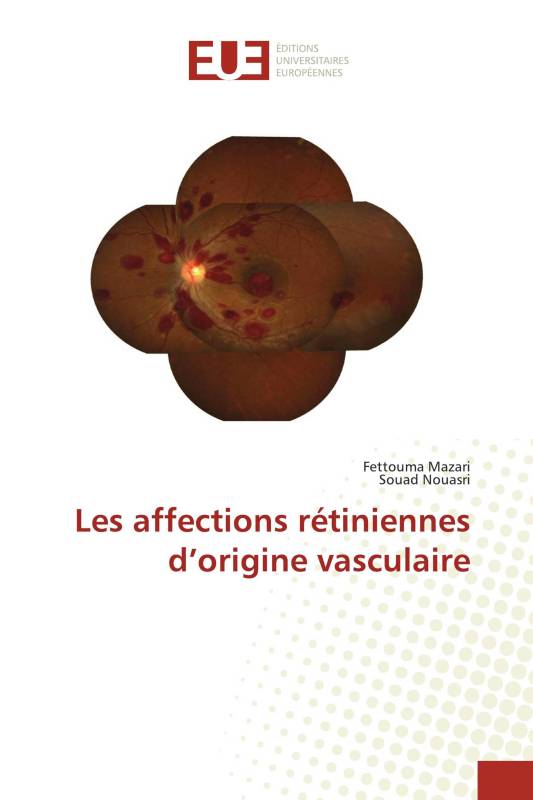 Les affections rétiniennes d’origine vasculaire